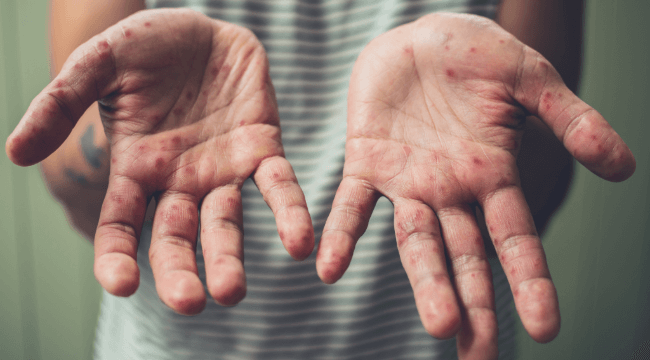 person holding hands out showing measles rash